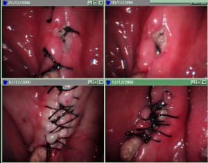 Complication pukfmg - Eugenol