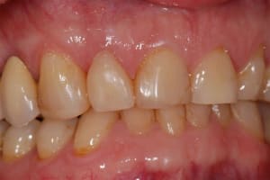 Couronne cerec mdiqnf - Eugenol