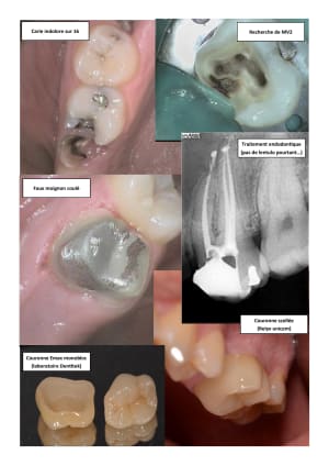 Couronne emax gehihl - Eugenol