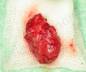 Cysta t8fndl - Eugenol