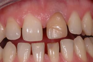 Début eclaircissement nqirkv - Eugenol