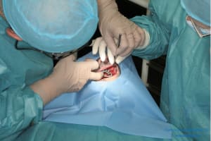 Déoulé d une mci dr r - Eugenol