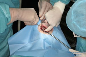 Déoulé d une mci dr r - Eugenol