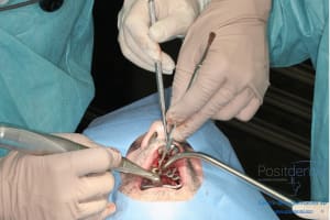 Déoulé d une mci dr r - Eugenol