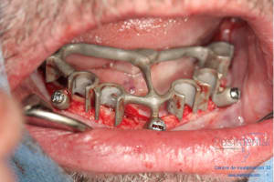 Déoulé d une mci dr r - Eugenol