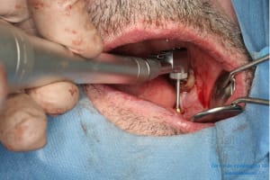 Déoulé d une mci dr r - Eugenol