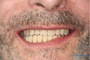 Déoulé d une mci dr r - Eugenol