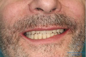 Déoulé d une mci dr r - Eugenol