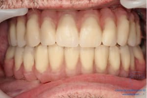 Déoulé d une mci dr r - Eugenol