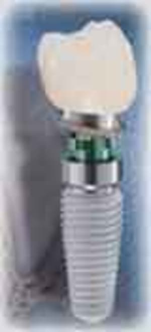 Dental implant01 r4lfr4 - Eugenol