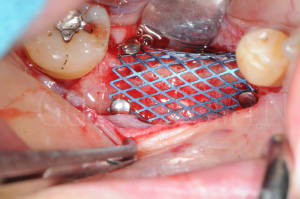 Dentiste implant mondelange 2 zw3j1g - Eugenol