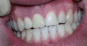Dentpro coegnn - Eugenol