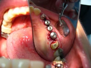 Dents1 018 b9arpa - Eugenol
