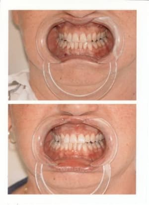 Eclaircissement ou dentosophie d7ttj1 - Eugenol