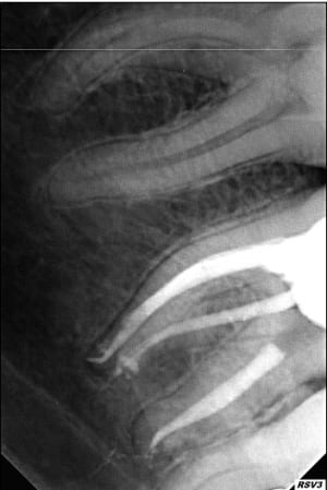 Endo 17  3  postop iprbqy - Eugenol