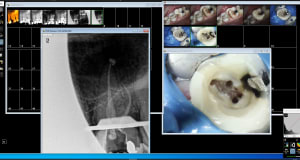 Endo 26 1 ptjeks - Eugenol
