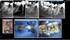 Endo 46 47 cov3wy - Eugenol