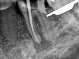 Endo x 2 - Eugenol