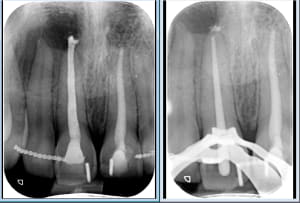 Endo apex ouvert fbwwxk - Eugenol