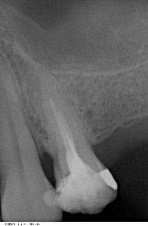 Endo avant u118xq - Eugenol