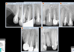 Endo depose reprise ou traitement initial ms9v2z - Eugenol