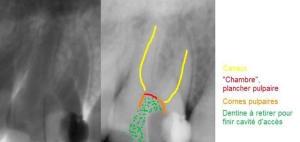 Endo hi5ocv - Eugenol