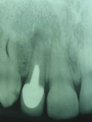 Endo ratée 3 df5tai - Eugenol