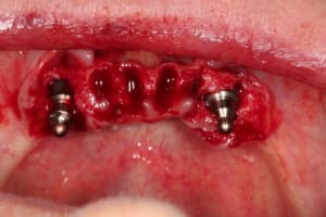 Extraction implantation iquifl - Eugenol