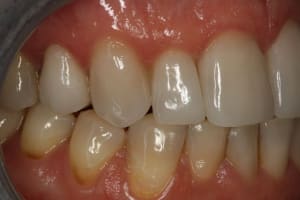 Facettes 13 wdxggt - Eugenol