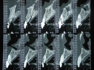 Fracture2 uwmnj0 - Eugenol
