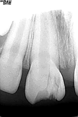 Fracture 11 kcuwxy - Eugenol