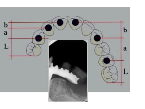 Fracture jvgnu7 - Eugenol