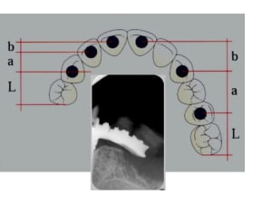 Fracture r2rpii - Eugenol