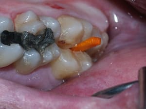 Fracture wnhjxv - Eugenol