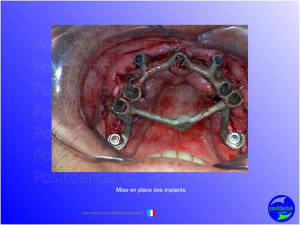 Guide chirurgical   mise en charge imm diate 008 rdspza - Eugenol