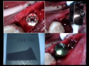 Implant 45 isq     ylioq9 - Eugenol