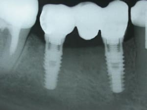 Implant dflhs3 - Eugenol