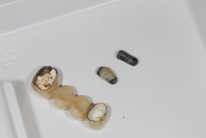 Implant qui drift depose wdnofp - Eugenol