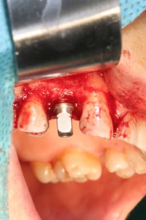 Implantation2 pegwmv - Eugenol