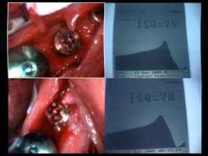 Implants 46 et 47 isq zjk5oi - Eugenol