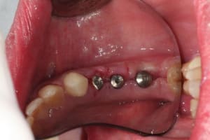 Implants sans fil ot1vm0 - Eugenol