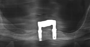 Implants symphysaires gr78yx - Eugenol
