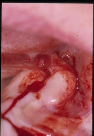 Incision ahidfa - Eugenol