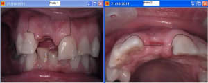 Incision tt0gtm - Eugenol