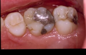 Inlay 3 pqdqe0 - Eugenol