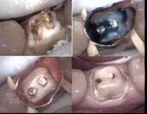 Inlay core p60   1 xmjlfn - Eugenol
