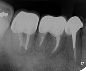 Lésion j8hdps - Eugenol
