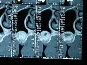 Lacune sinus 2 tmvbq0 - Eugenol