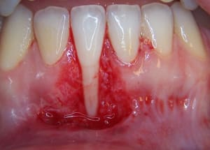 Lit receveur bf5bsr - Eugenol