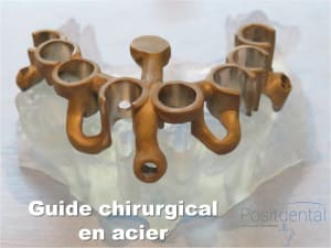 Mise en charge immédiate   implant tov  positdental 001 kdmdo9 - Eugenol